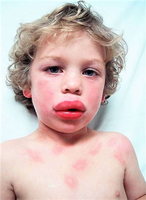 allergic reaction to lips uk